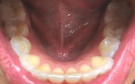 Bottom of Teeth